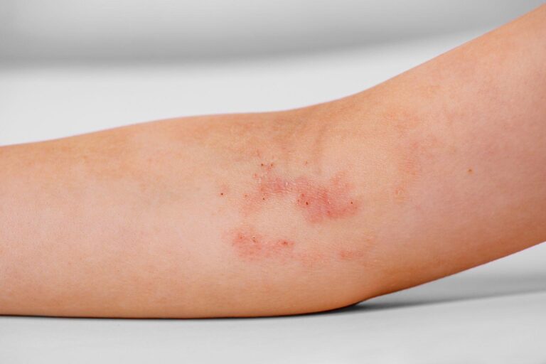 Atopic dermatitis : understanding the causes, symptoms and treatment options.