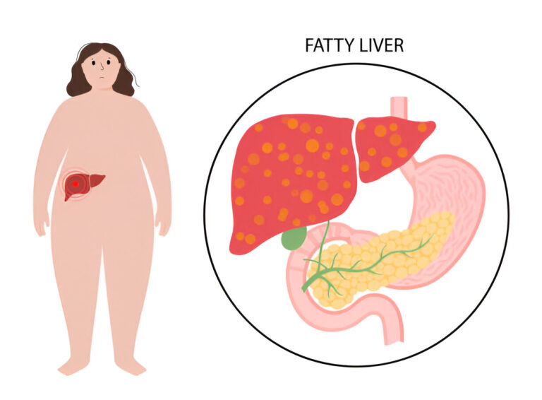 Understanding Fatty Liver Disease: From Simple Fat Build-Up (NAFLD) to Serious Damage (NASH)